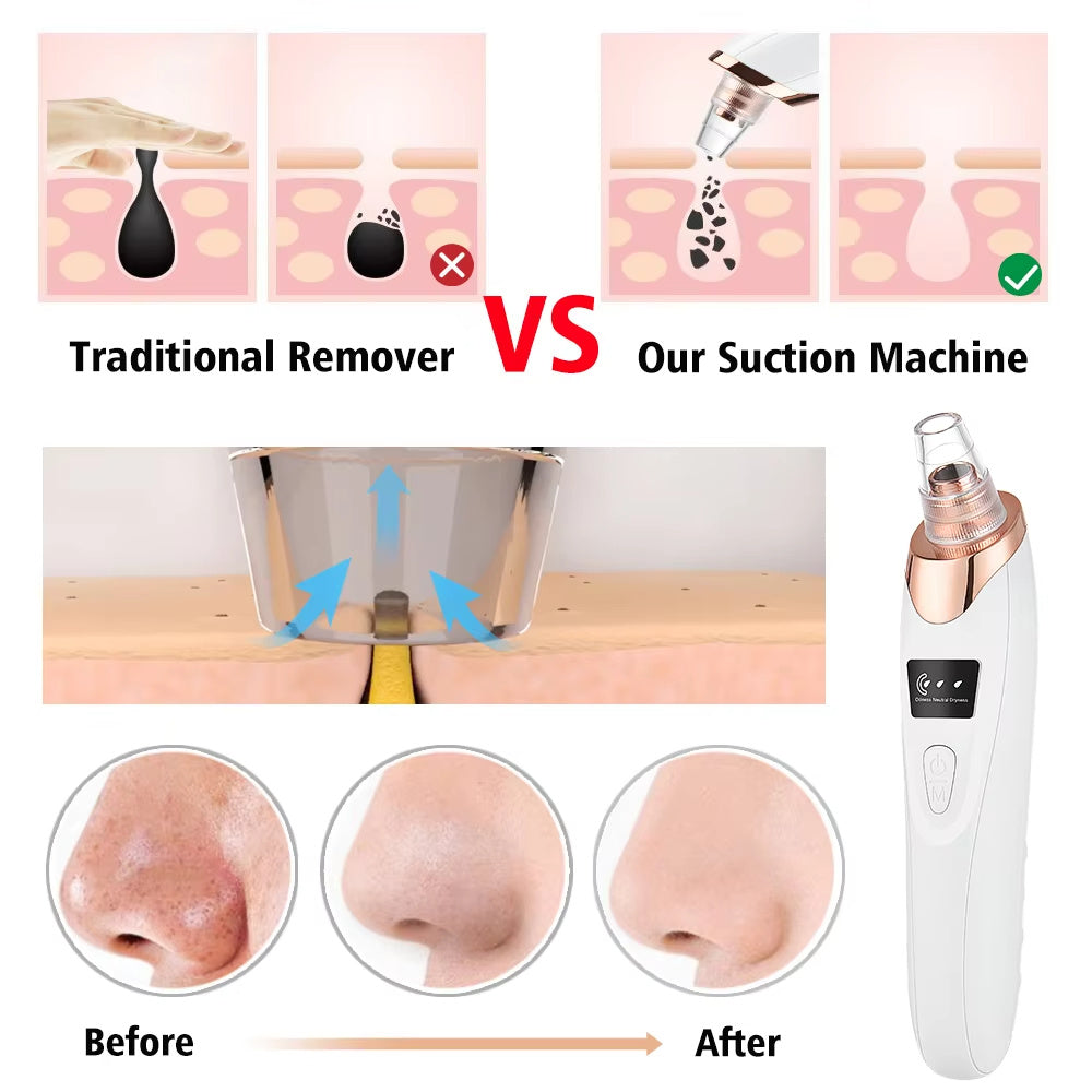 Electric Professional Blackhead Remover Black Pimple Blemish Beauty Women Skin Care Facial Cleaning Pimple Remover Tool Kit Electric Professional Blackhead Remover Black Pimple Blemish Beauty Women Skin Care Facial Cleaning Pimple Remover Tool Kit